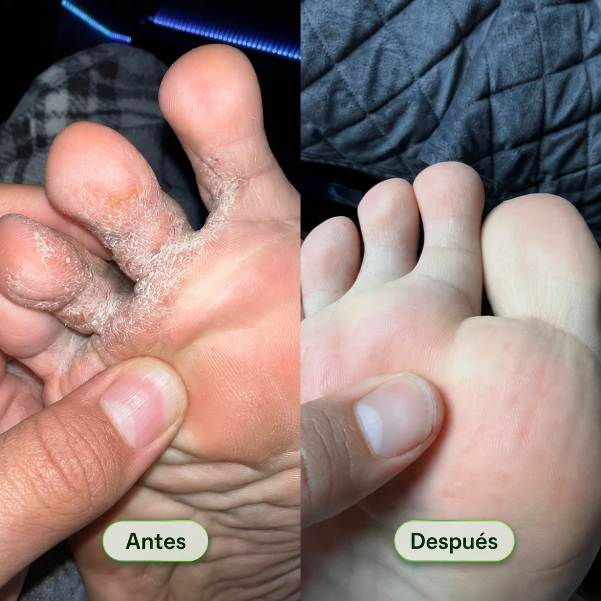 Nyla® Jabón Antimicótico Purificante